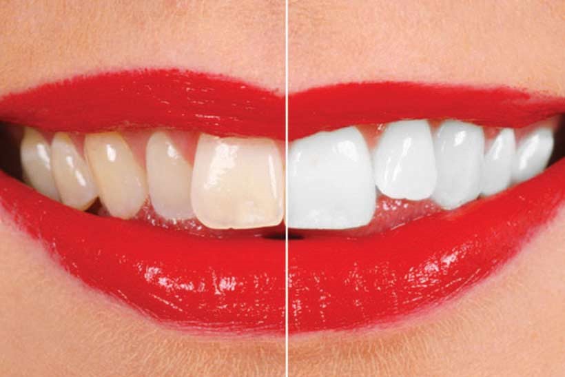 ۶ روش آسان برای سفید کردن دندان ها